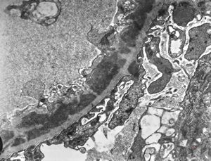 M,37y. | type I membranoproliferative glomerulonephritis (mesangiocapillary) M,37y. | type I membranoproliferative glomerulonephritis (mesangiocapillary)